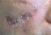 치료전