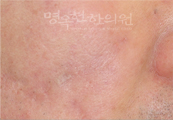 치료후