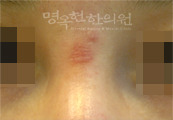 치료전