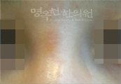 치료후