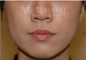 치료후