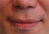 치료전