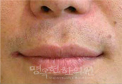 치료후