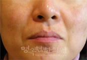 치료전