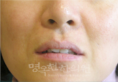 치료후