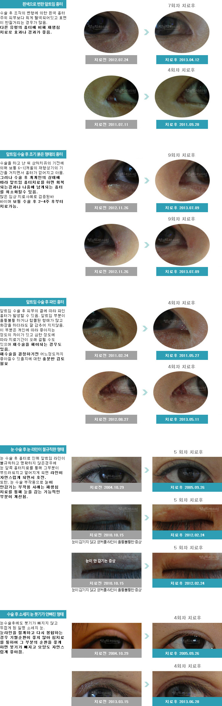 앞트임흉터,눈수술흉터 유형과 치료