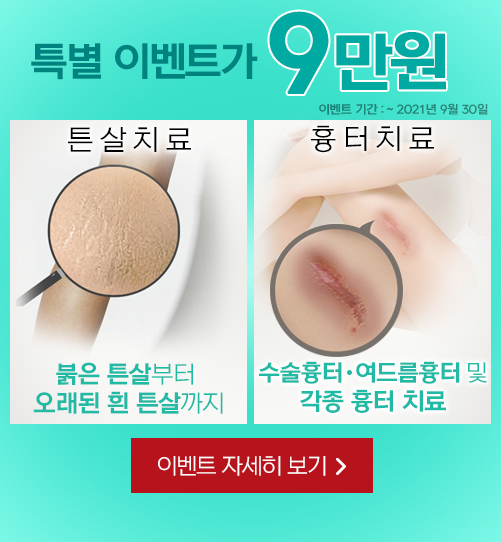 튼살치료, 흉터치료 9만원 특별 이벤트